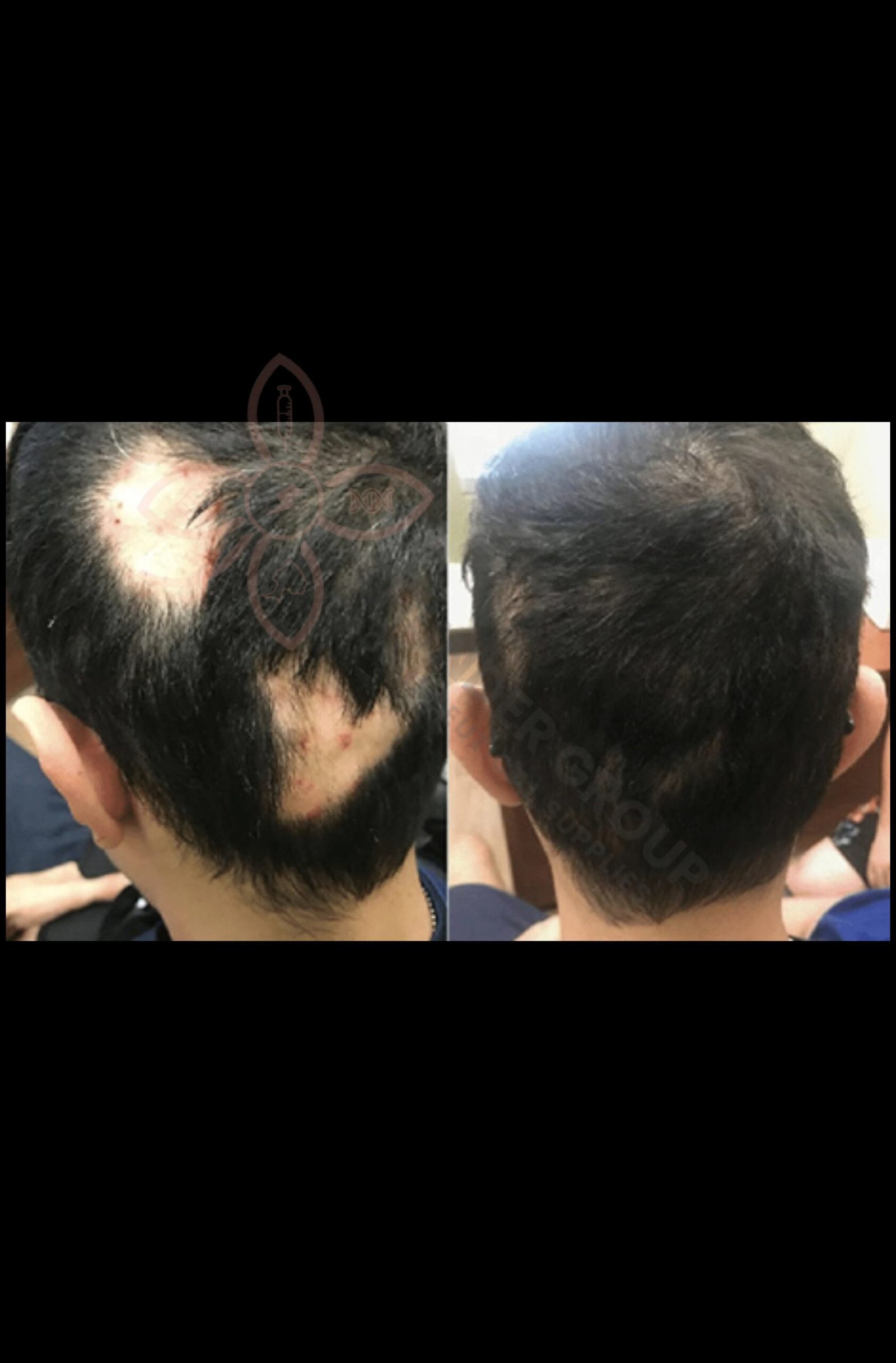 Mesologica Dutasteride® - Image 2