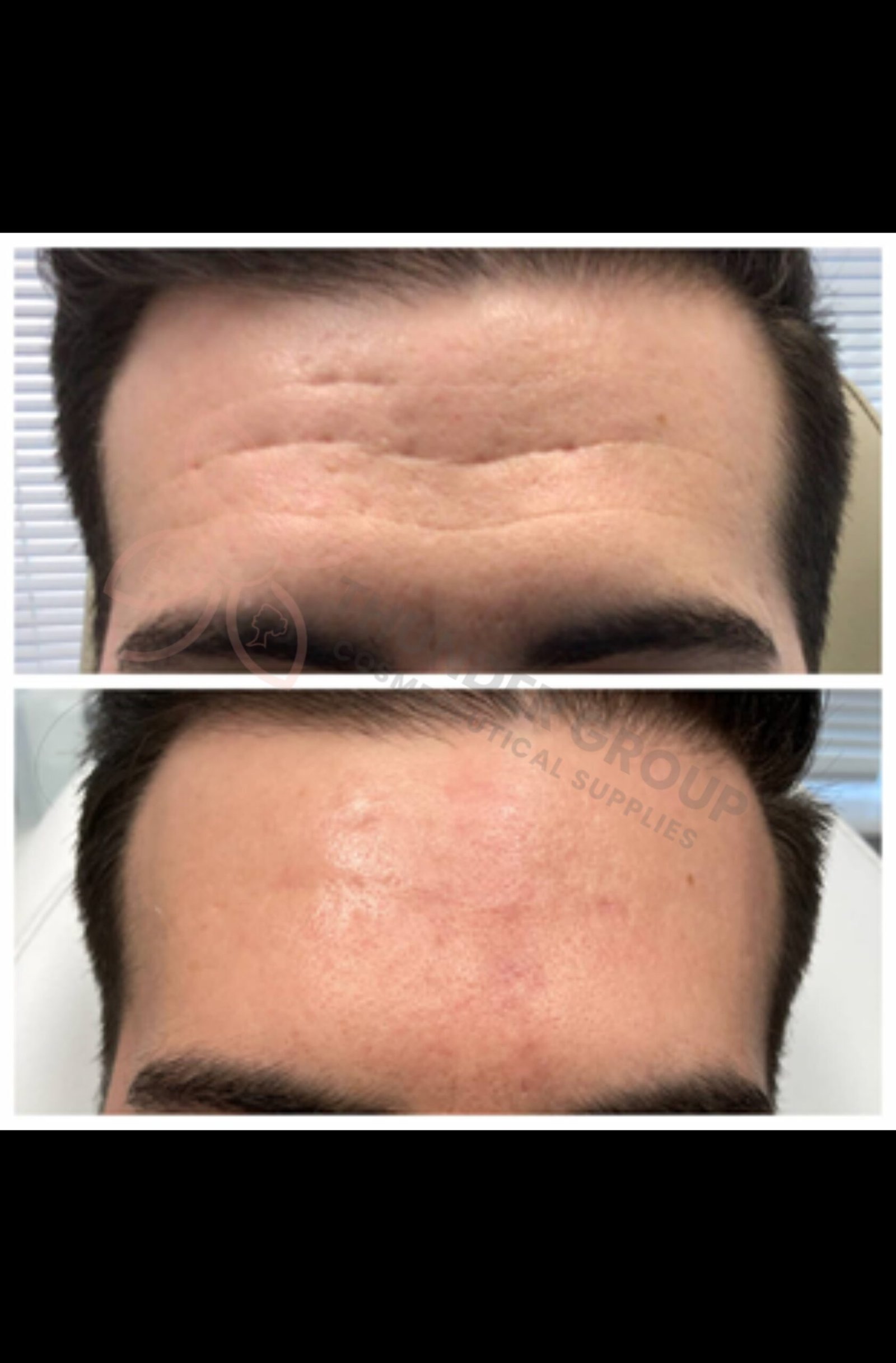 Replengen™ Fine Cross-Linked HA (24mg/ml) + Lidocaine 0.3% - Image 4