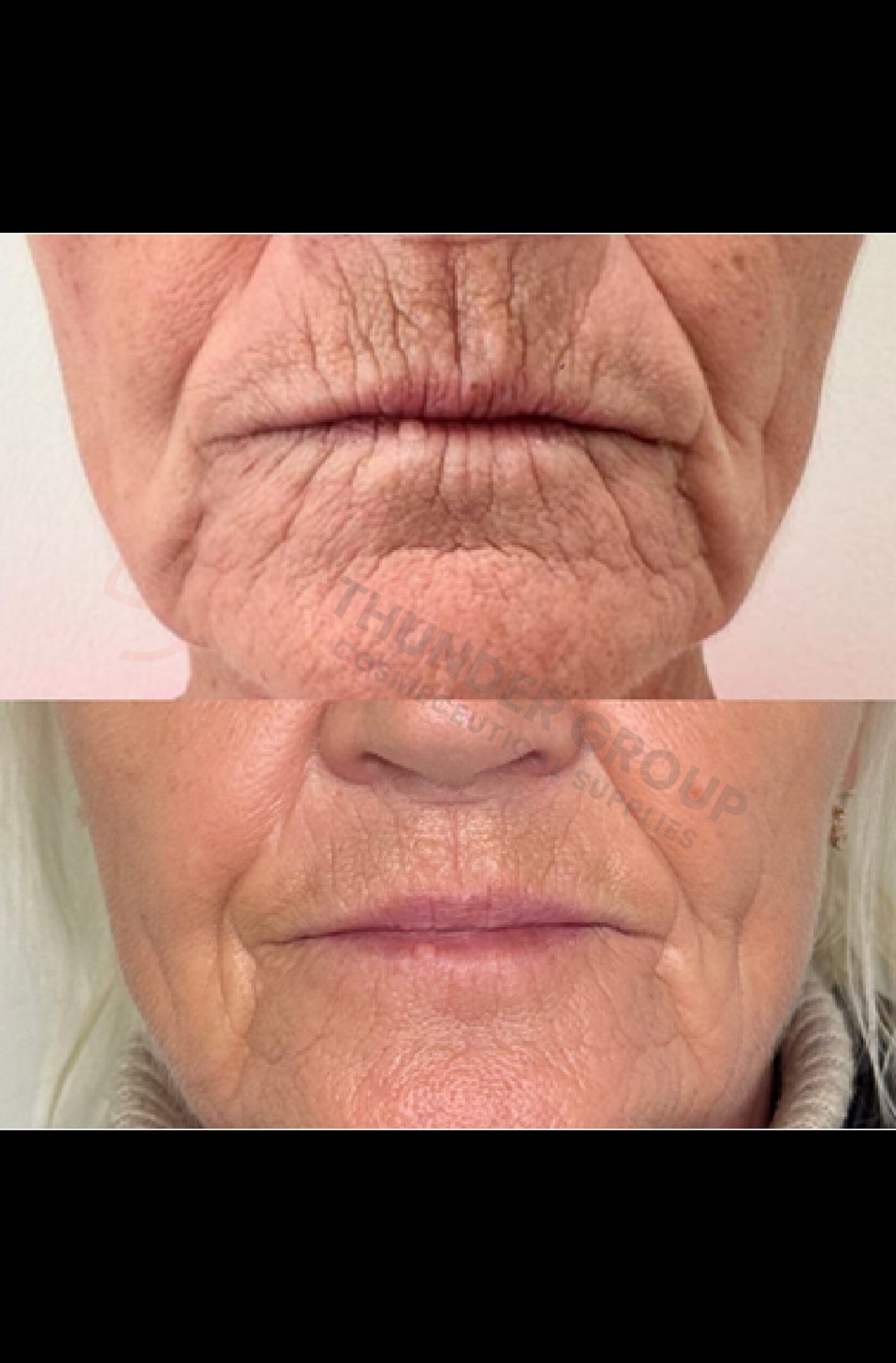 Replengen™ Fine Cross-Linked HA (24mg/ml) + Lidocaine 0.3% - Image 3